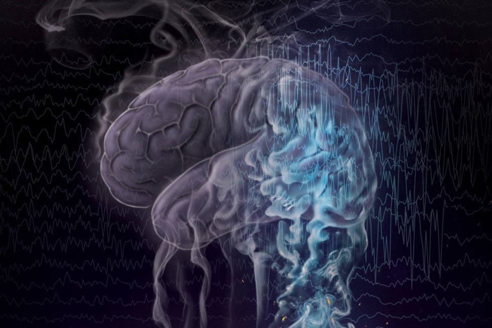 New Method Promises to Make Diagnosis, Treatment of Epilepsy More